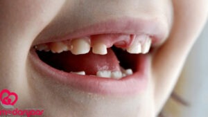 روند پوسیدگی دندان در کودکان